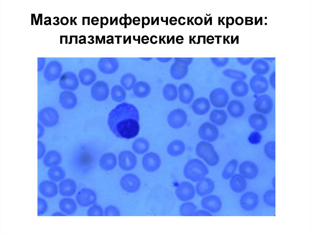 1 плазматическая клетка. Миеломная болезнь плазматические клетки мазок крови. Плазматические клетки плазмоциты. Плазматические клетки в мазке крови. Плазмоцит в мазке крови.