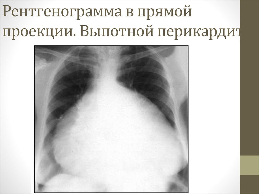 При выпотном перикардите на рентгенограмме наблюдается легочный рисунок тест ответ