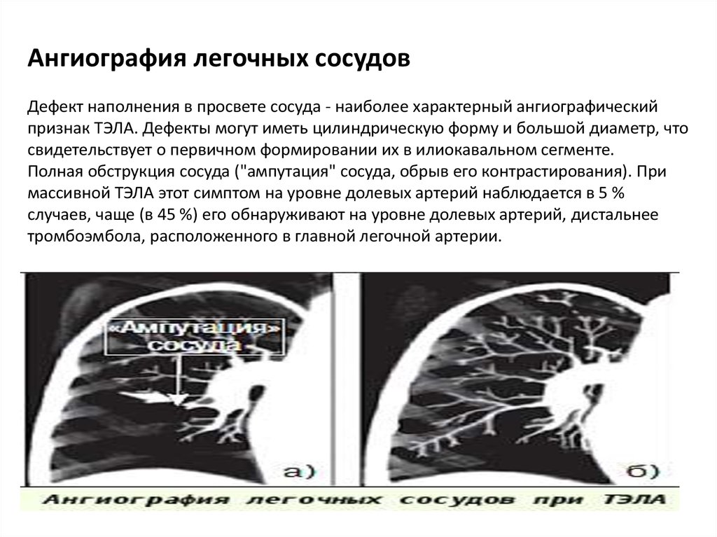 Тромбоэмболия легочной артерии мкб 10