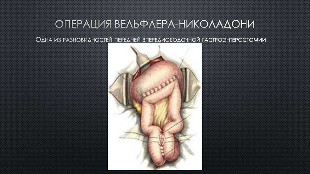 Операция Вельфлера-николадони