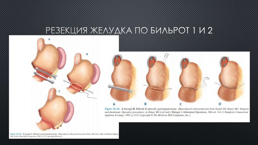 Бильрот 1 и 2 схема кратко