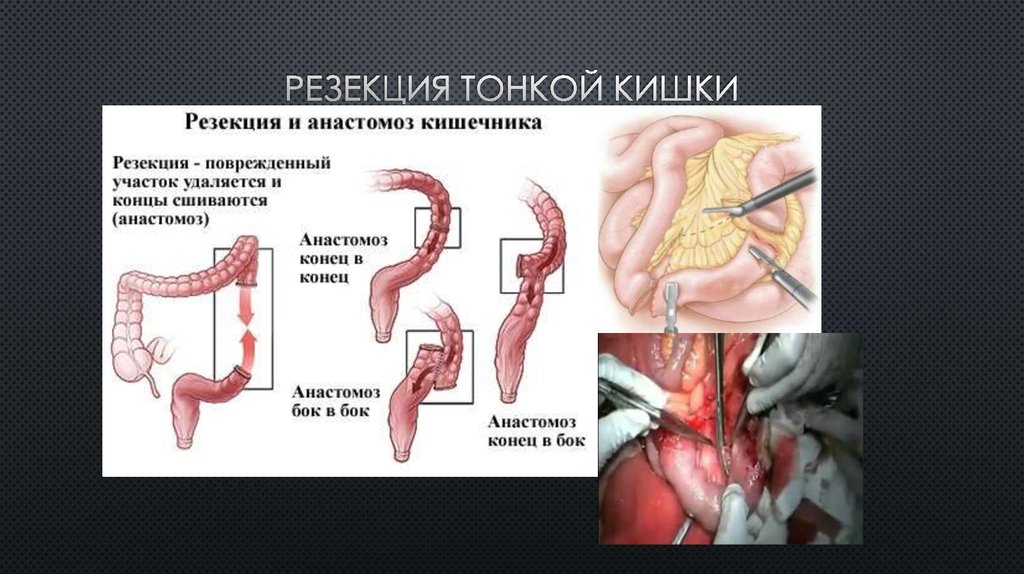 Резекция тонкой кишки