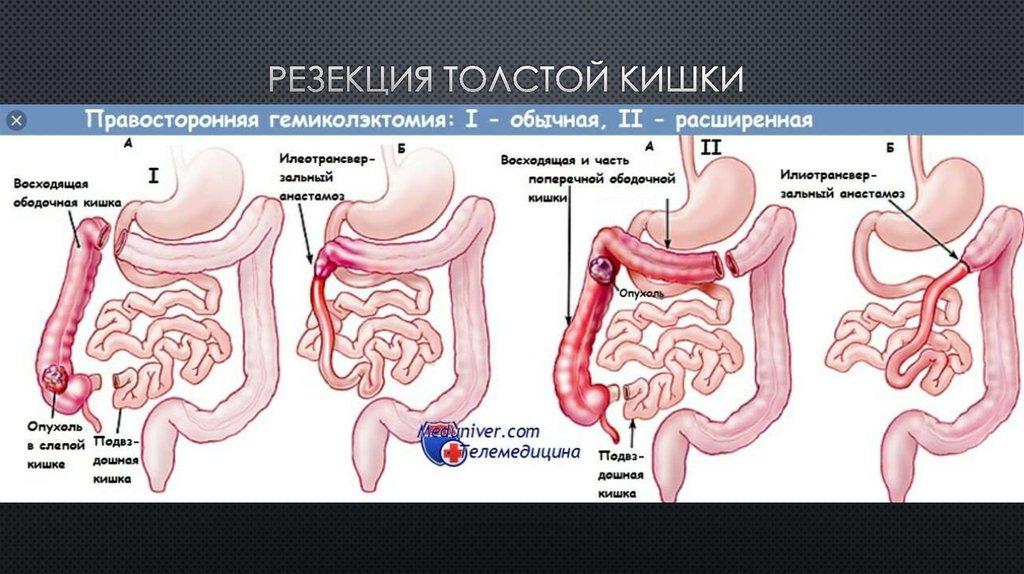 Резекция толстой кишки