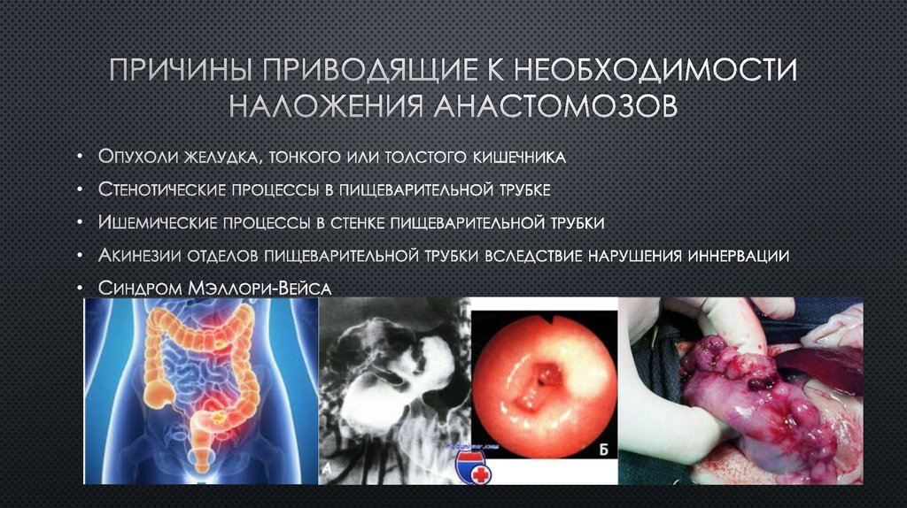 Причины приводящие к необходимости наложения анастомозов