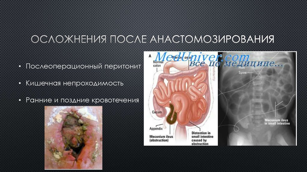 Осложнения после анастомозирования