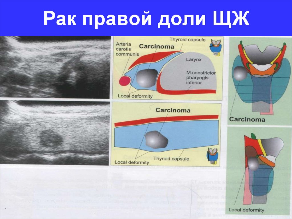 Рак правого. Правая доля щитовидной железы. Нижний полюс правой доли щитовидной железы. Фото правой доли щитовидной железы. Деформация правой доли щитовидной железы.