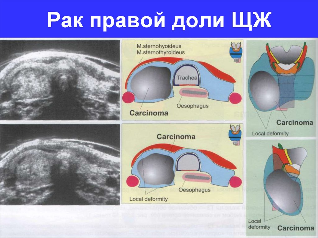 Доле правого. Neo правой доли. Гюртлеклетояная карцинома правой доли щитовидной железы.