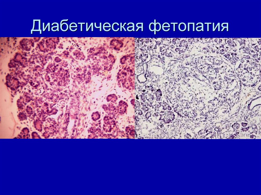 Диабетическая фетопатия презентация