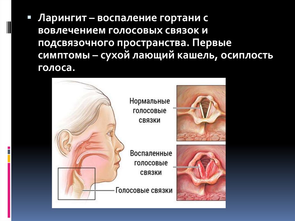 Заболевания голосовых