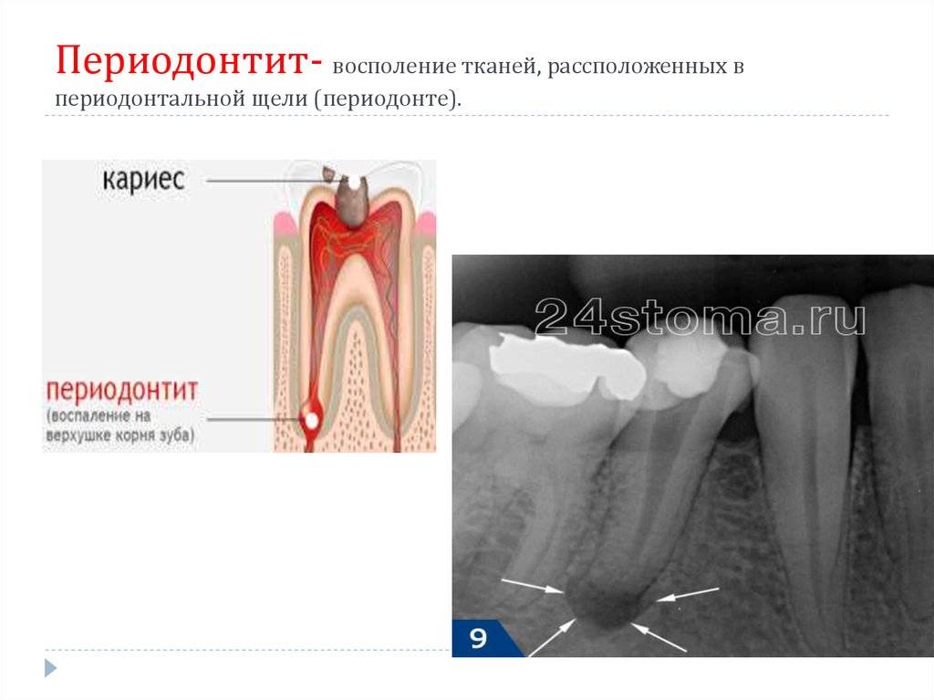 Методы лечения периодонтита презентация