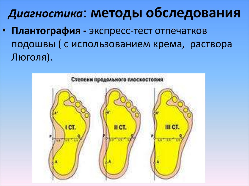 Степени продольного плоскостопия