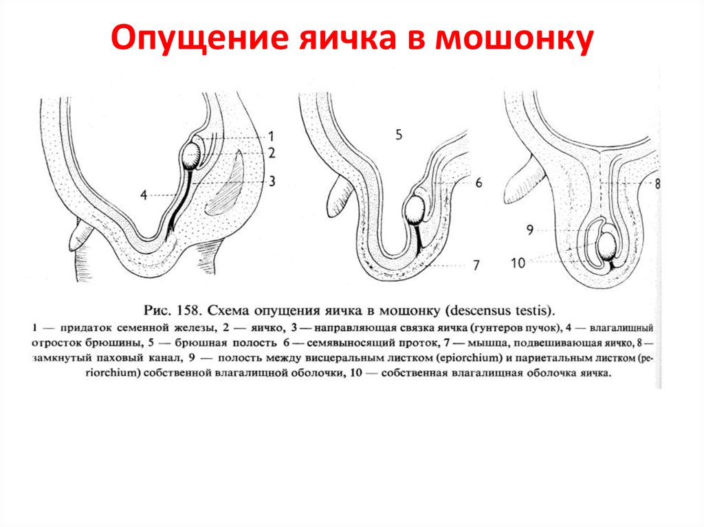 Анорхизм яичек картинка