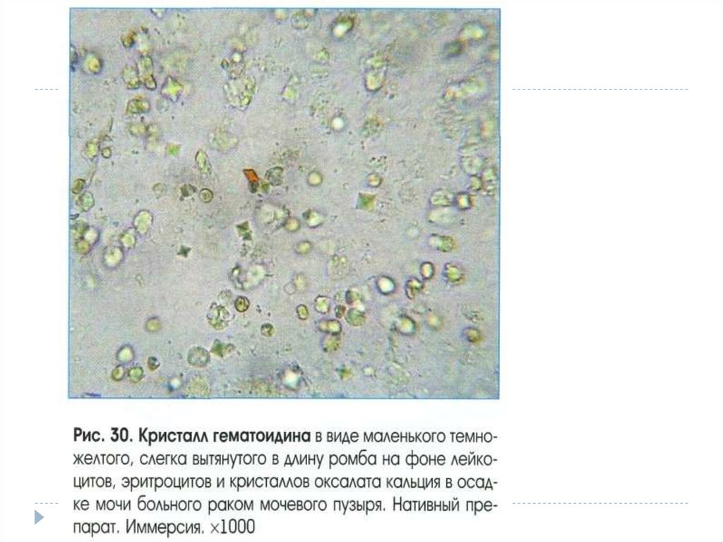Кристаллы кальция в моче у мужчин. Карбонат кальция микроскопия. Микроскопия мочи мелкие Кристаллы. Карбонат кальция под микроскопом в моче. Карбонат кальция в осадке мочи.