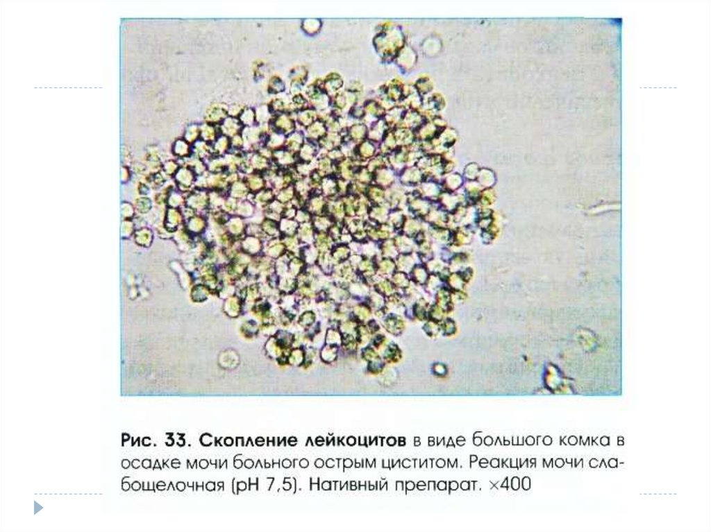 Клетки дунаевского в моче при глпс фото