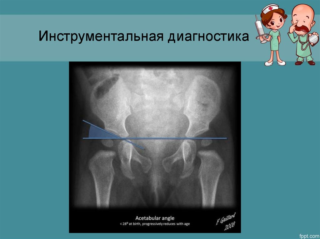 Дисплазия это. Дисплазия ТБС презентация. Дисплазия тазобедренного сустава презентация. Дисплазия тазобедренного сустава ppt. Дисплазия тазобедренного сустава у детей презентация.