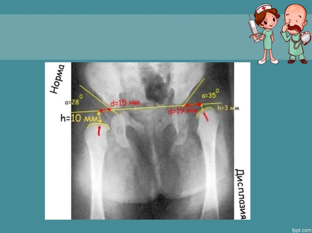 Презентация дисплазия тазобедренных суставов