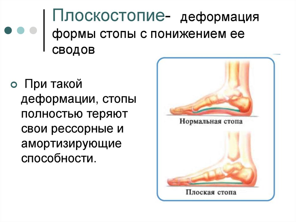 Плоскостопие презентация ортопедия