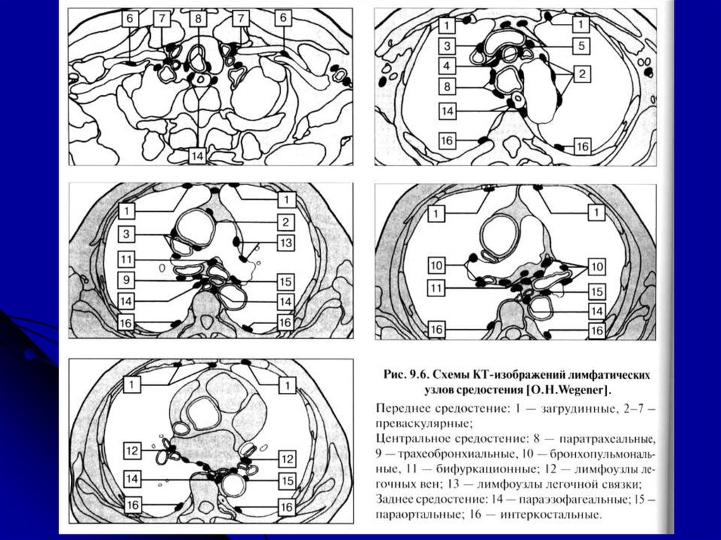 Лимфоузлы средостения схема расположения