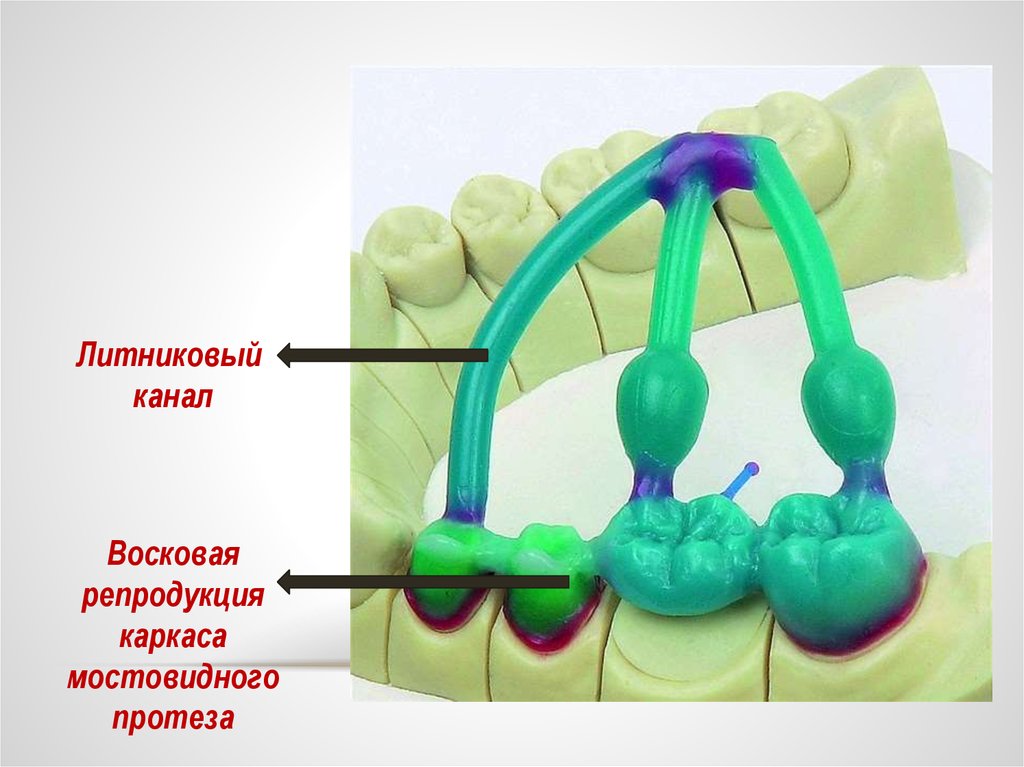 Части мостовидного протеза. Литниковая система для вакуумного литья. Литниковая система бюгельного протеза. Литниковая система мостовидного протеза. Литниковая система коронки.