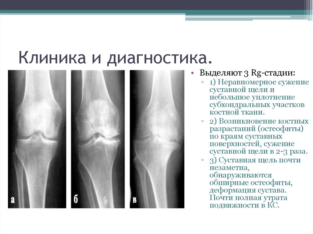 Гонартроз по утвержденным клиническим рекомендациям. Гонартроз 2-3 степени рентген. Остеоартроз коленного сустава рентген. Гонартроз 3 степени коленного сустава рентген. Сужение суставной щели коленного сустава до 3 мм.