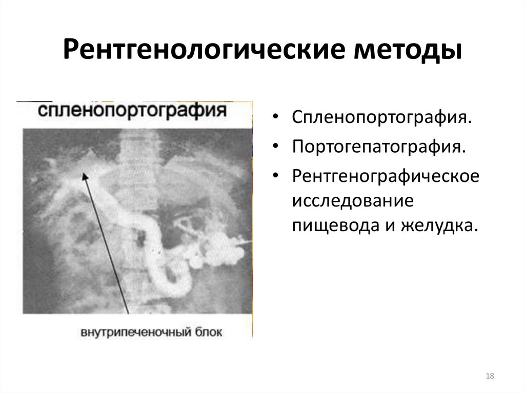 Исследование пищевода. Рентгенологические методы исследования пищевода. Спленопортография при портальной гипертензии. Рентгенологические методы исследования пищевода и желудка.