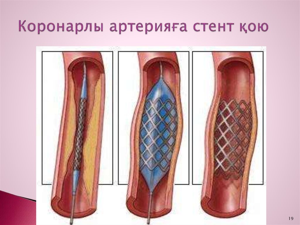 Коронарлы артерияға стент қою