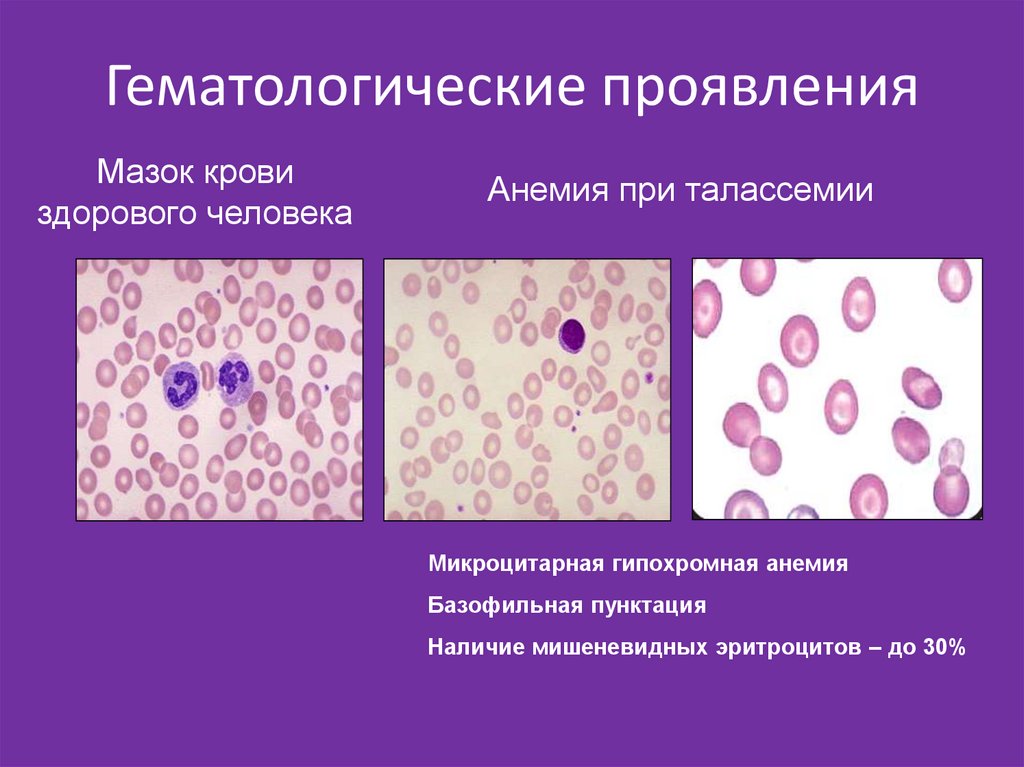 Картина периферической крови при железодефицитной анемии