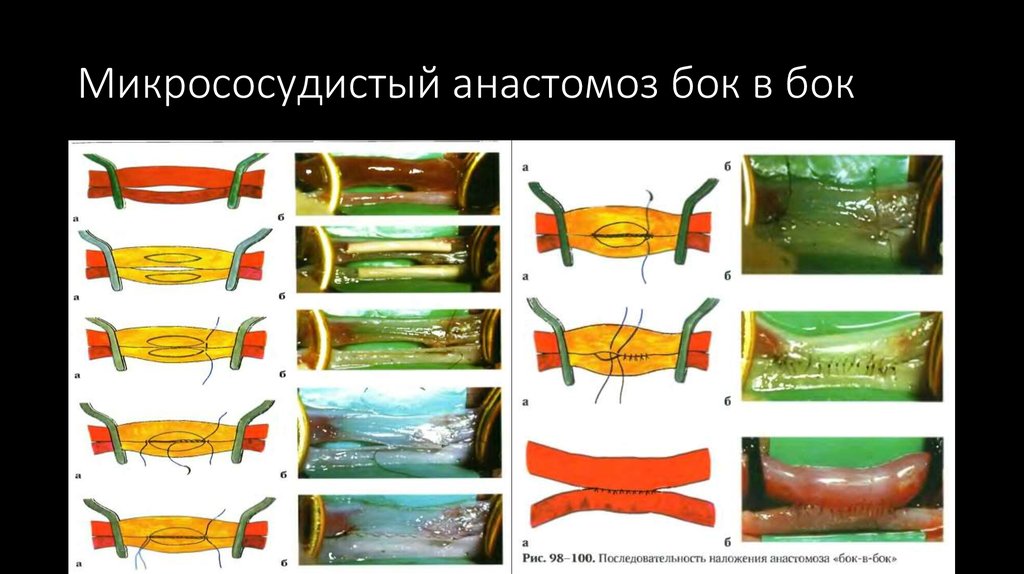 Лоскуты на микрососудистом анастомозе применяемые в челюстно лицевой хирургии презентация