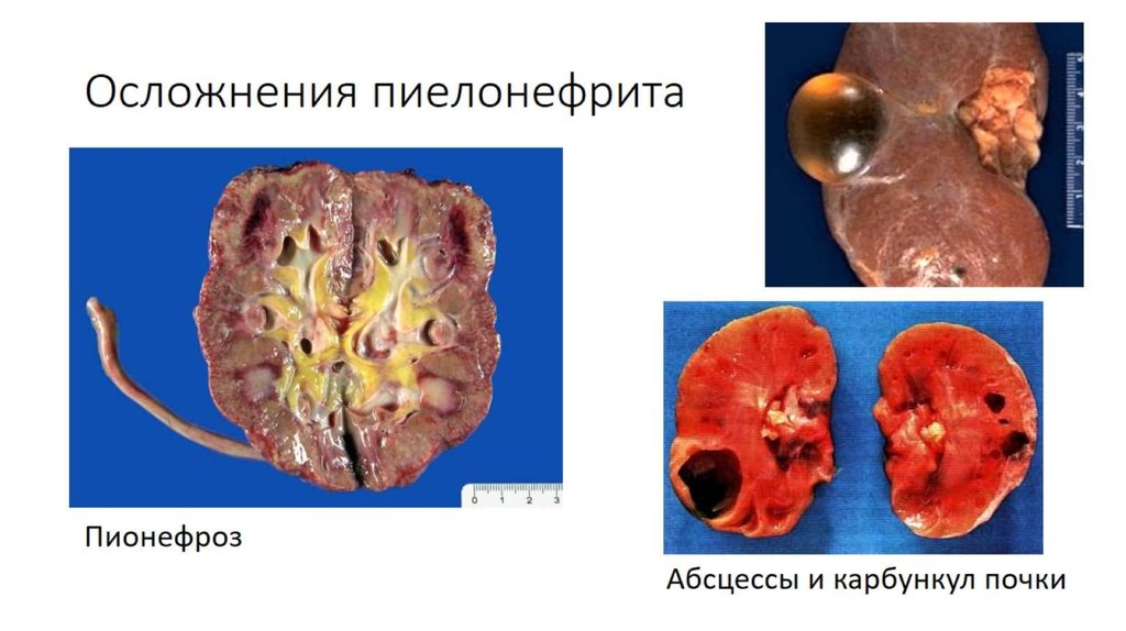 Осложнения пиелонефрита