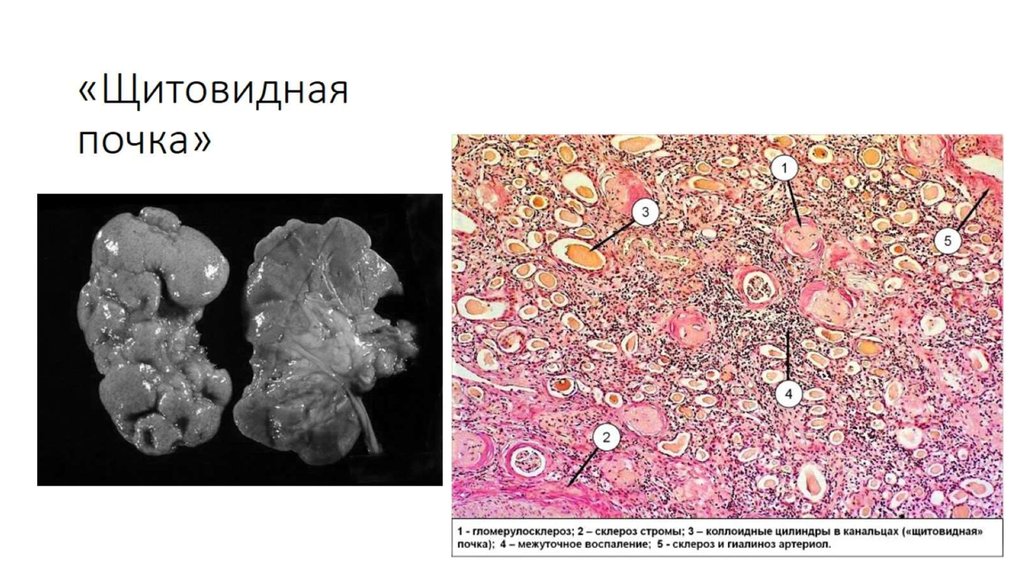 «Щитовидная почка»