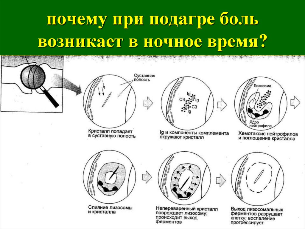 Подагра патогенез. Суставного синдрома при подагре. Патогенез подагры схема. Патогенез острого подагрического артрита. Подагра патогенез суставного синдрома.