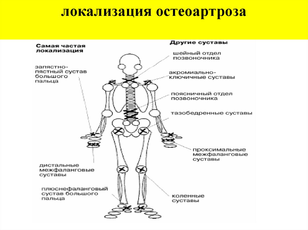 Названия суставов человека. Локализация остеоартроза. Суставной синдром презентация. Типичная локализация суставного синдрома. Локализация это.
