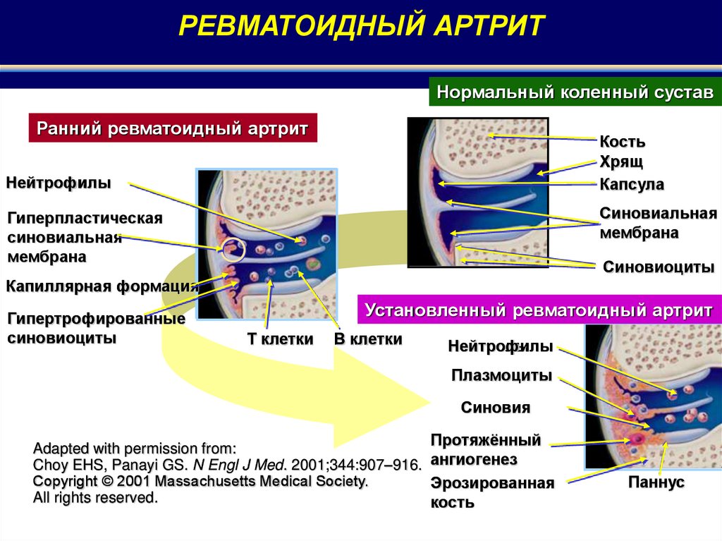 Суставной синдром презентация