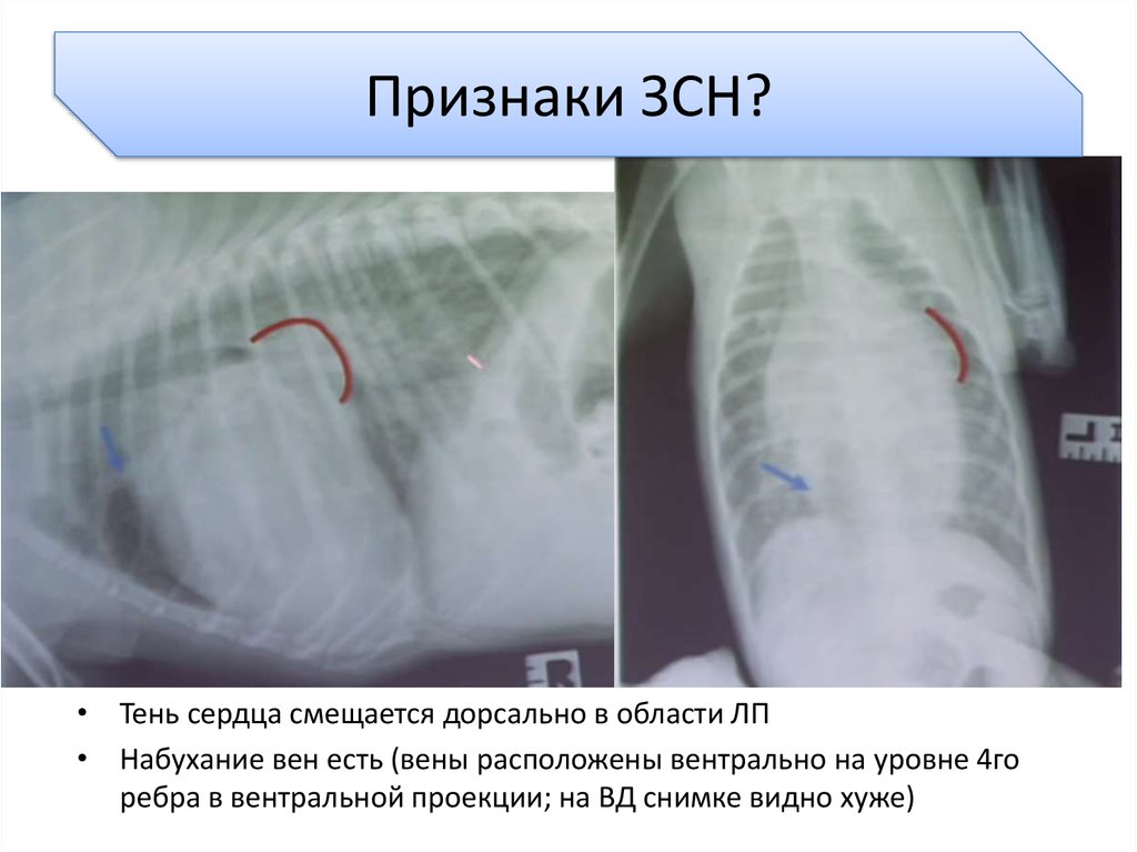 Дорсальной вене. Тень сердца. Может ли сместиться сердце.