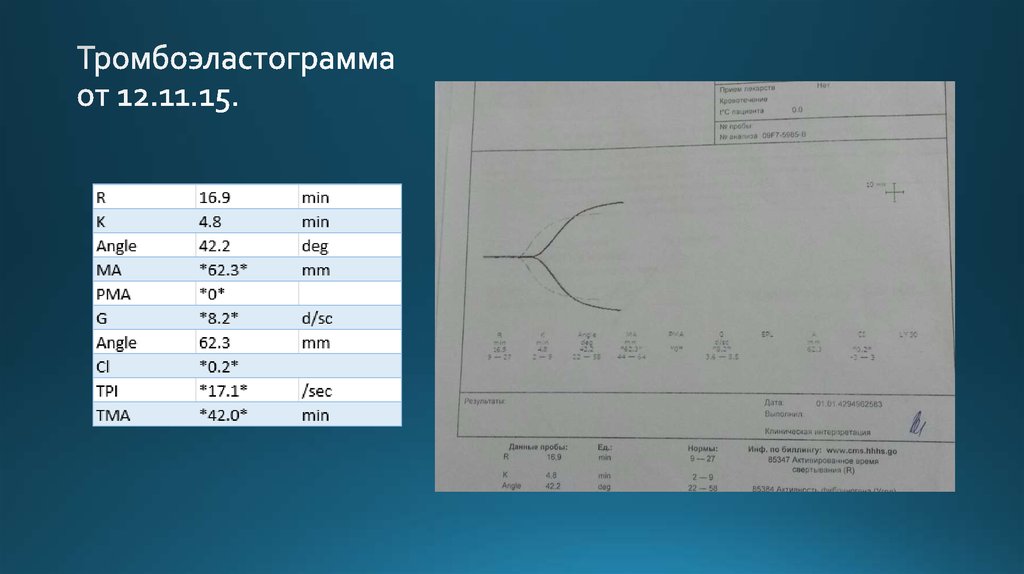 Тромбоэластограмма от 12.11.15.