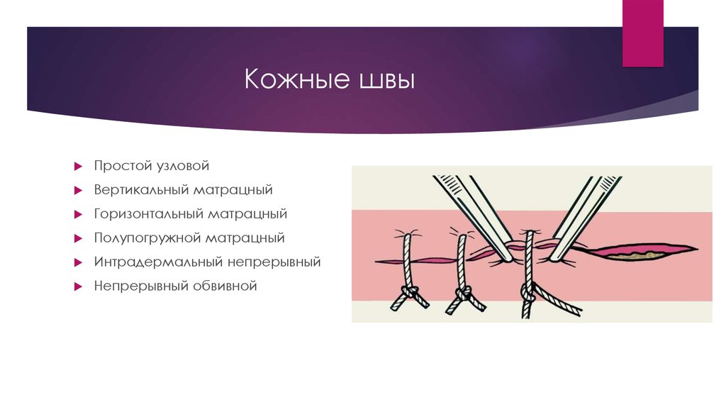 Виды хирургических швов презентация