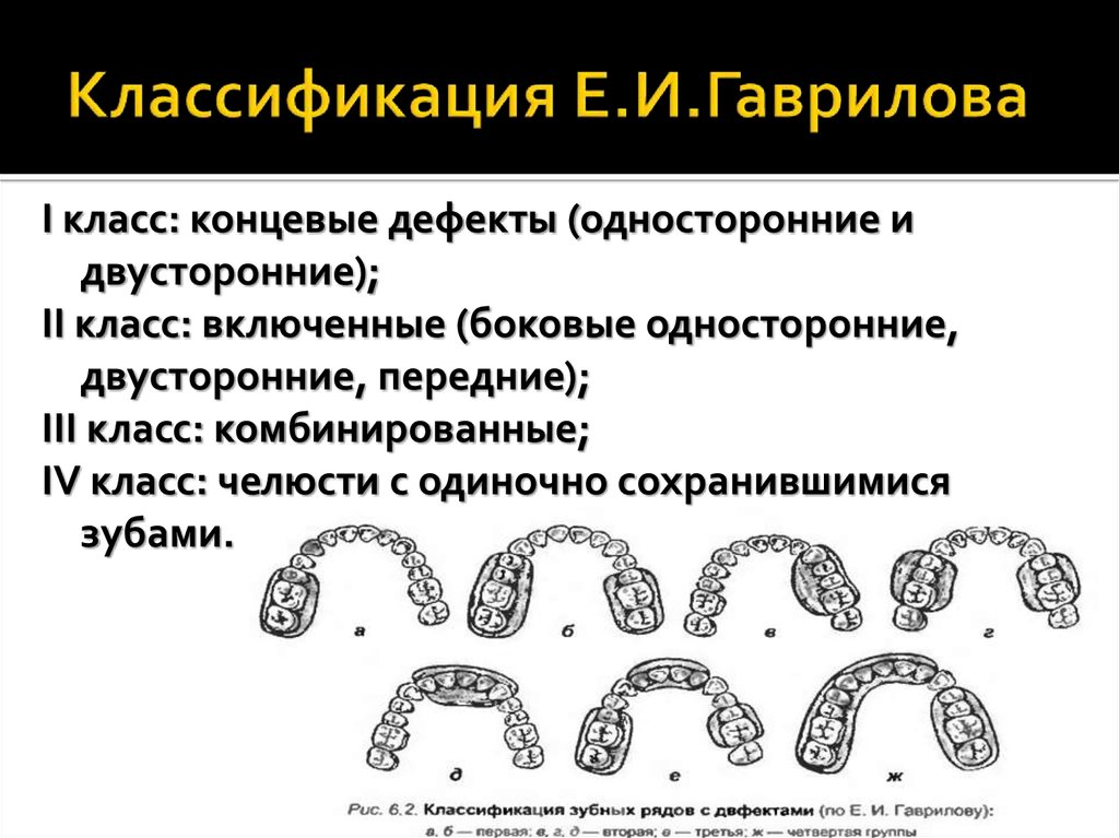 Классификация зубных. Классификация Гаврилова дефекты зубных рядов. Классификация Гаврилова в ортопедической стоматологии. Классификация дефектов зубных рядов по е.и. Гаврилову. Классификация дефетов зубных пядомгаврилова.