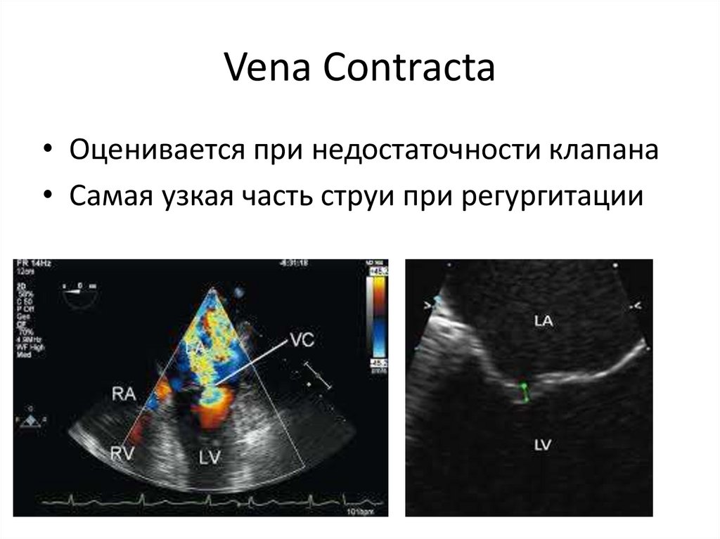 Аортальная недостаточность регургитация. Аортальная недостаточность ЭХОКГ. Аортальная регургитация эхокардиография. Вена контракта в эхокардиографии при митральной недостаточности.