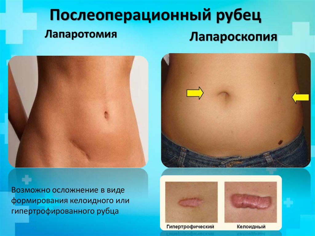 Послеоперационный рубец