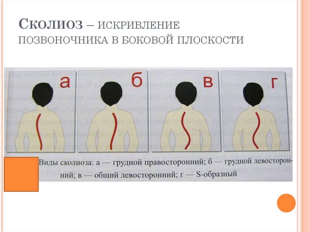 Левое правое плечо. Правосторонний и левосторонний сколиоз. S образный сколиоз правосторонний грудной. Сколиоз искривление позвоночника в плоскости.