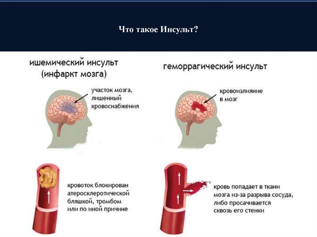 Что такое инсульт. Инсультная атака что это.