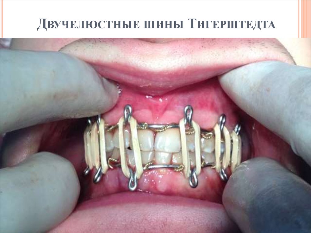 Эффективность применения двучелюстных шин Тигерштедта по сравнению с ...