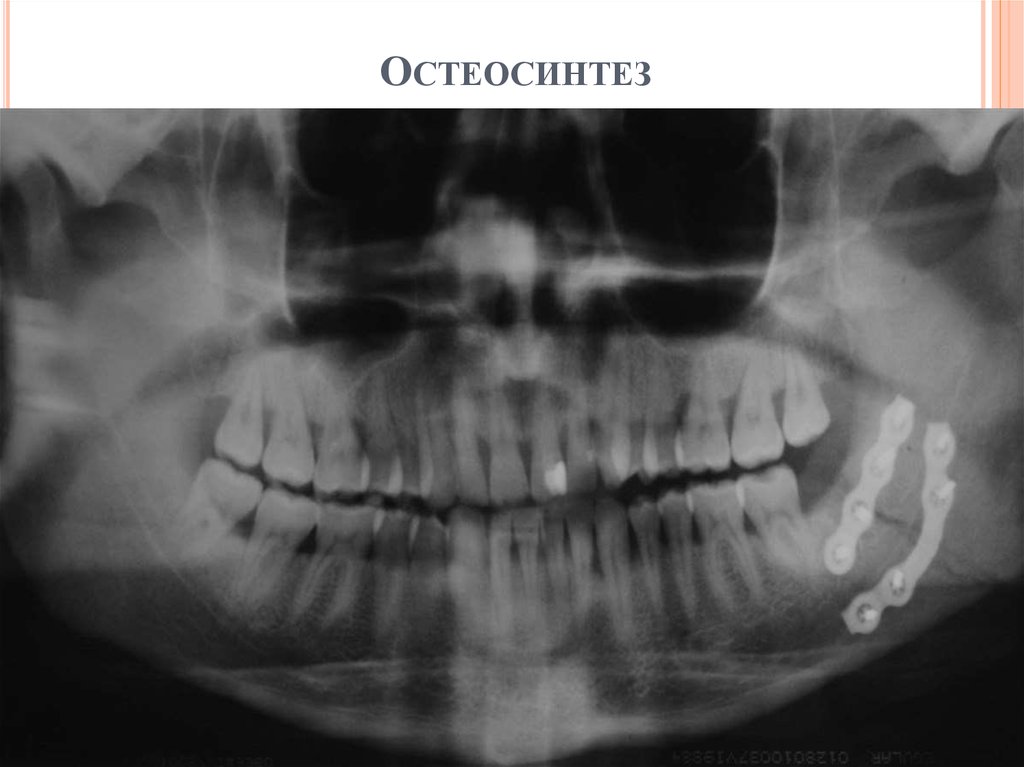 Остеосинтез