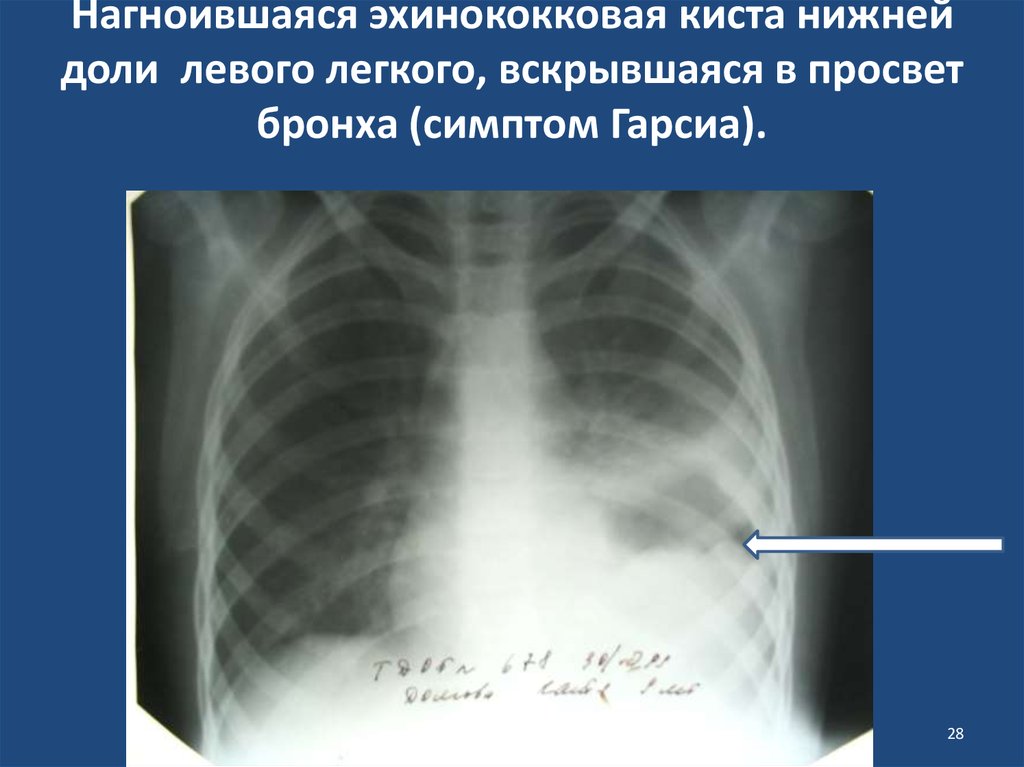 Киста легкого. Нагноившаяся киста легкого. Эхинококковая киста в легком. Эхинококковые кисты в легких.