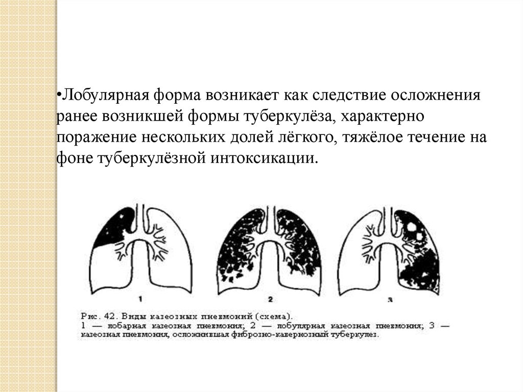 Казеозная пневмония презентация