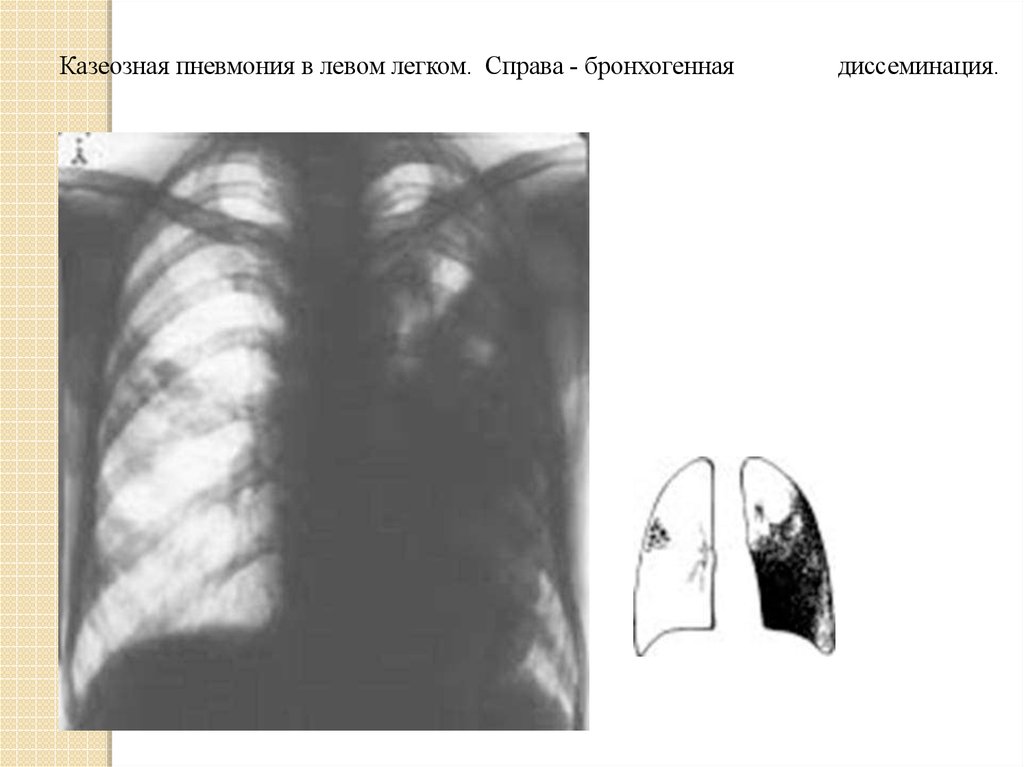 Казеозная пневмония схема