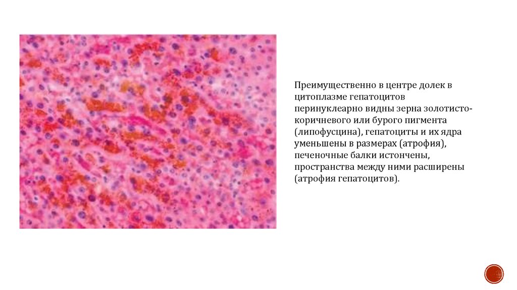 Процесс сопровождающийся накоплением в цитоплазме гепатоцитов. Бурая атрофия печени макропрепарат. Бурая атрофия печени патанатомия. Мускатная печень микропрепарат рисунок. Бурая атрофия печени микропрепарат патологическая анатомия.