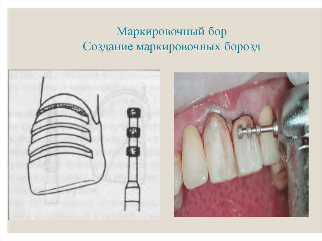 Препарирование под металлическую коронку схема