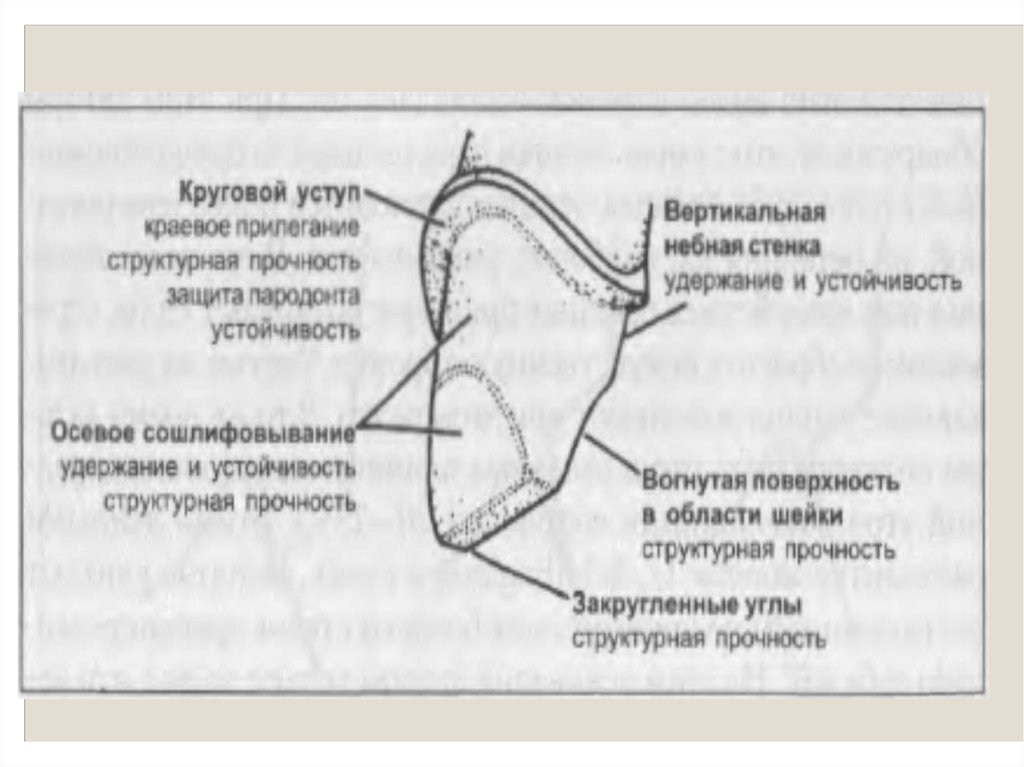 Препарирование под металлическую коронку схема