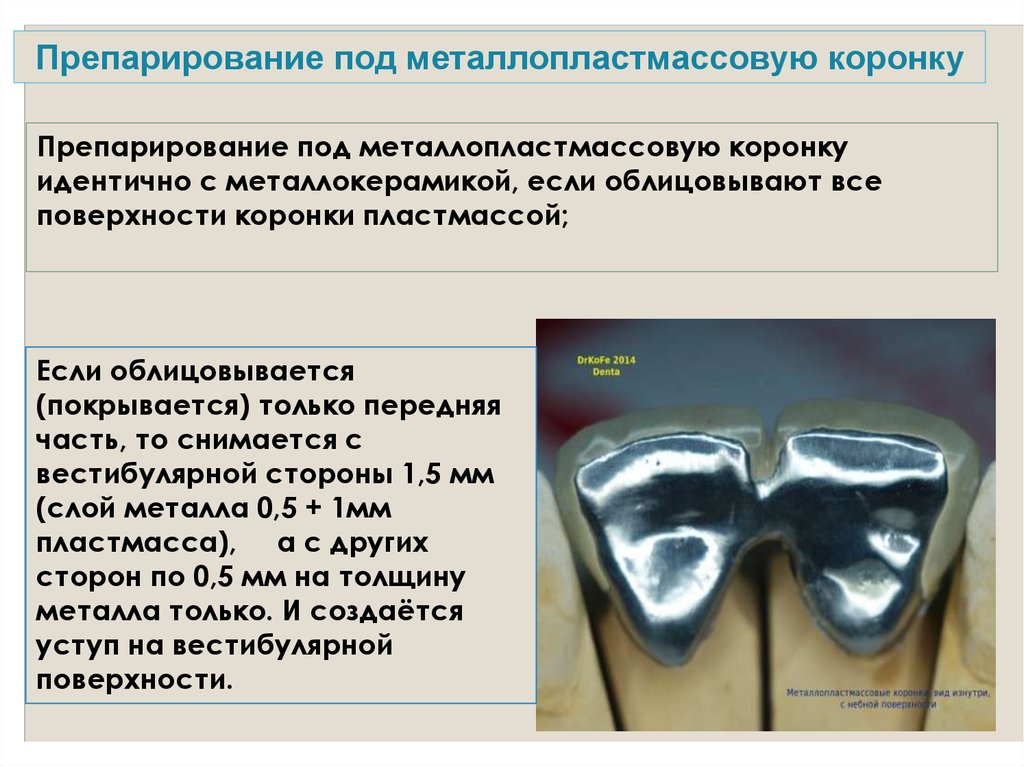 Металлические коронки презентация